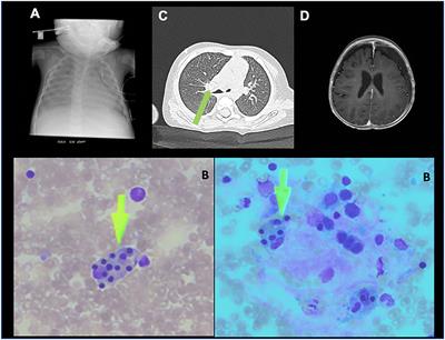 Tuberculosis-Associated HLH in an 8-Month-Old Infant: A Case Report and Review